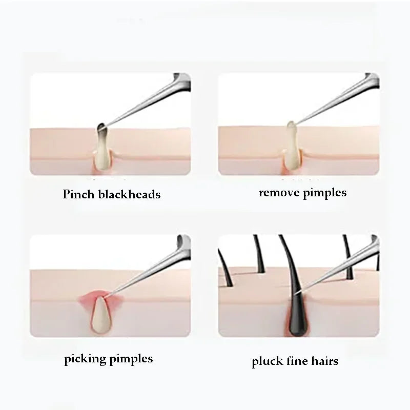 Blackhead & Ingrown Hair Removal Tool Set (4-11pcs)
